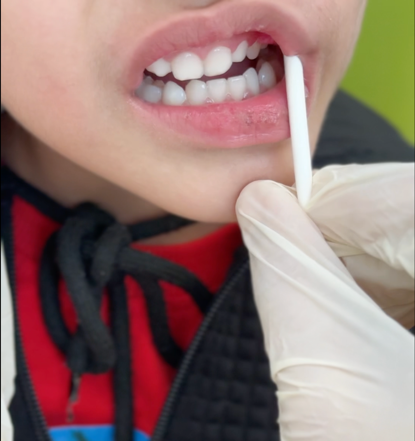 Close-up of a child's mouth during an oral motor therapy session with a speech therapist using a cotton swab for stimulation
